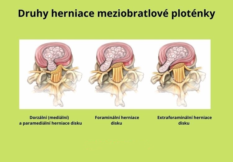 Jak se projevuje výhřez ploténky?